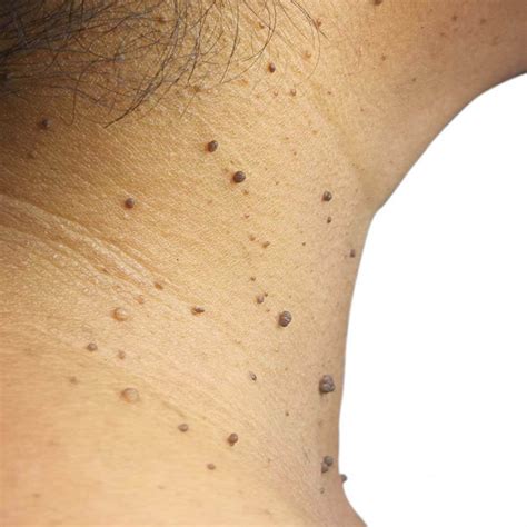 Dermatosis Papulosa Nigra Kristal Skin And Laser Clinic
