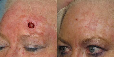 Forehead Reconstruction Gallery Skin Cancer And Reconstructive