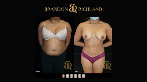 Renuvion Skin Tightening Before And After Smooth Results Dr Brandon