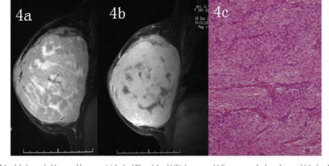 Table 2 From Imaging Findings In Phyllodes Tumors Of The Breast