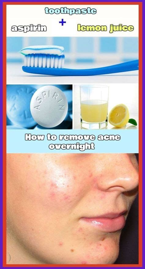 Best Way To Get Rid Of Acne Overnight Find Out How To Remove Pimples