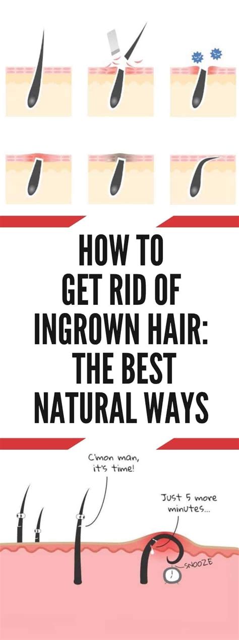 How To Get Rid Of Ingrown Hair The Best Natural Ways Ingrownhairthigh Ingrown Hair Ingrown