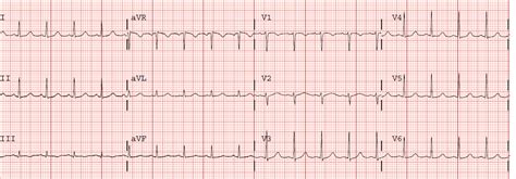 Dr Smiths Ecg Blog Slightly Peaked T Waves What Is It
