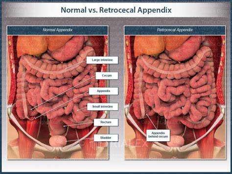 Normal Vs Retrocecal Appendix Trialexhibits Inc
