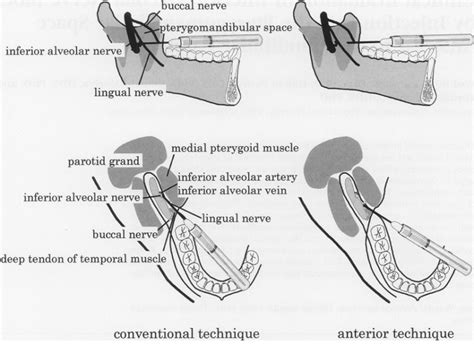 Inferior Alveolar Nerve Block Dentalorgcom