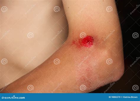 Scraped Up Bleeding Elbow Stock Photo Image 9886570
