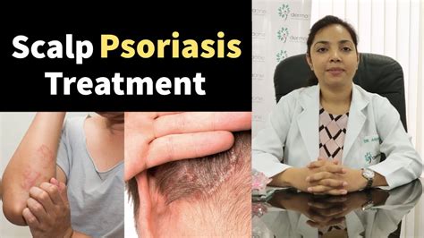 Psoriasis Scalp Psoriasis Symptoms Types Causes Diet Relief And