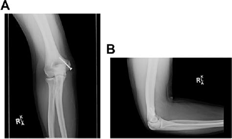 A Anterior And B Lateral View Radiographs 3 Months Postoperatively