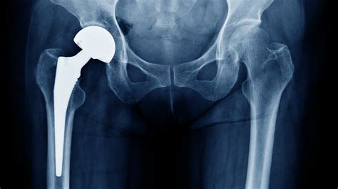 Hip Replacement Materials The Best And Worst Kinds To Use