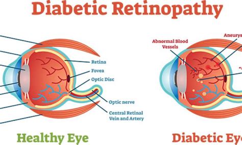 Eye Health Blog Diabetic Retinopathy Insights Iris