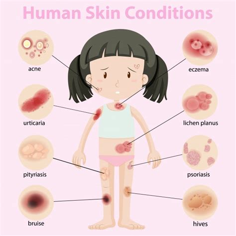 Free Vector Diagram Showing Human Skin Conditions