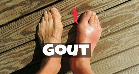 Gout Punca Rawatan Dan Cara Untuk Mengelakkannya