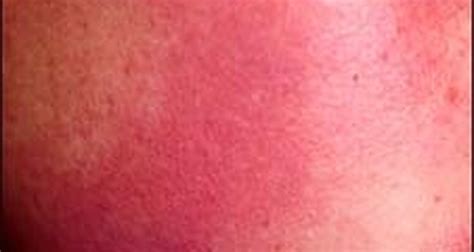 Keratosis Pilaris Rubra Face Treatment