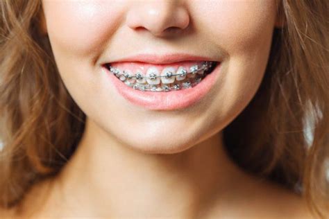 how to deal with swollen gums due to braces shirck orthodontics ohio orthodontists