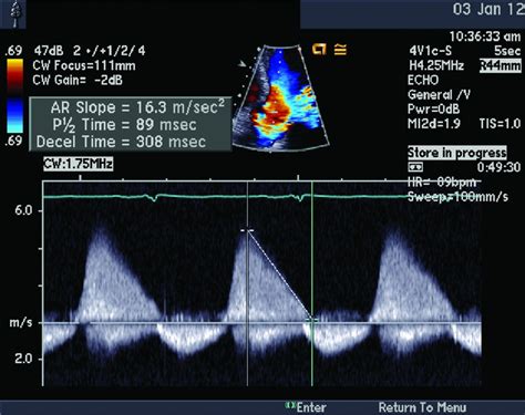 Classic Hemodynamic Findings Of Severe Aortic Regurgitation Circulation