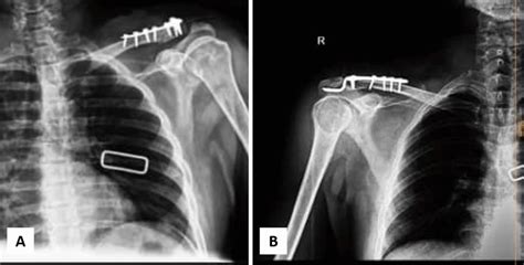 Distal Clavicle Fracture Fixation Using A T Plate And B Hook Plate