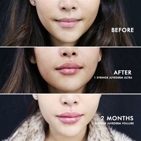 How Much Lip Fillers Cost In India