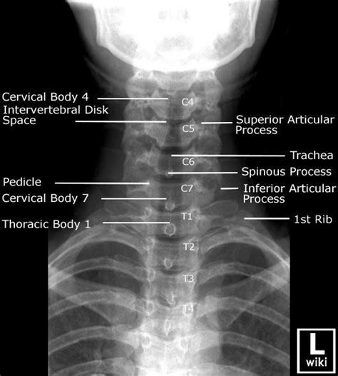 Cervical Spine Radiographic Anatomy Radiology Student Anatomy