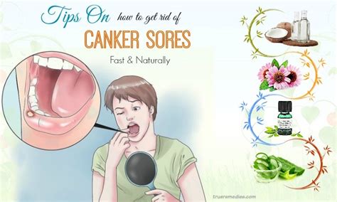 30 Tips On How To Get Rid Of Canker Sores Fast
