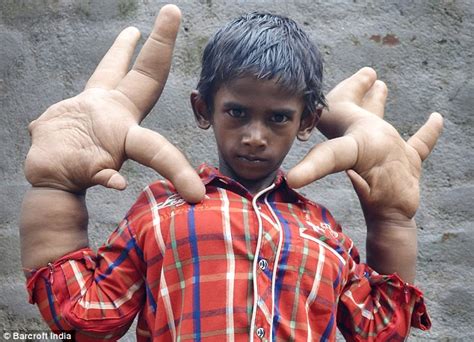 Indian Boy With Giant Hands From Local Gigantism Gets Life Changing