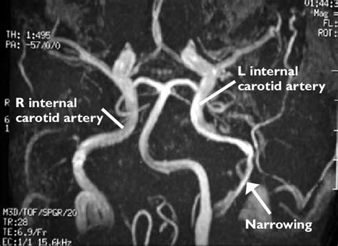 Magnetic Resonance Angiogram Showing Narrowing And Stenosis Of The