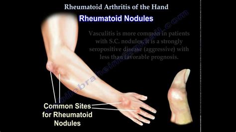 Rheumatoid Arthritis Of The Hand Everything You Need To Know Dr