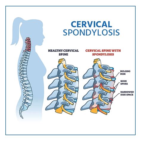 Understanding Cervical Spondylosis Causes Symptoms And Treatment