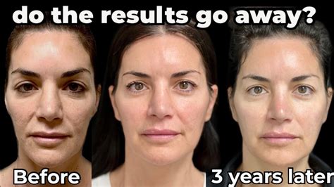 how long does sculptra last sculptra face transformation before and after youtube