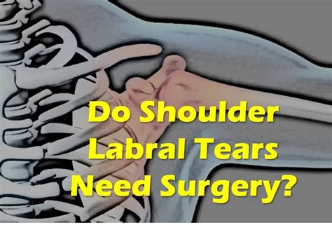 Tearing of the labrum can be found in shoulders of all age groups. do shoulder labral tears need surgery