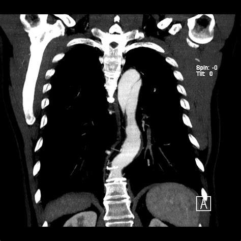 Aortic Dissection Debakey Type Iii Stanford B Image