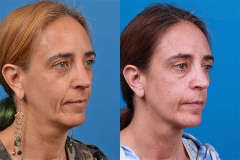 Patient 122406547 Laser Assisted Weekend Neck Lift Before And After