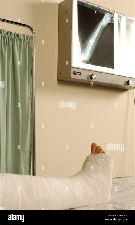 A Person Lying On A Hospital Bed With Their Broken Leg In A Cast Stock