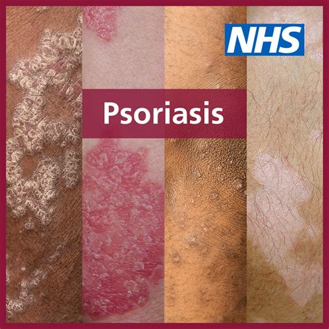 Nhsuk Its World Psoriasis Day Psoriasis Is A Skin