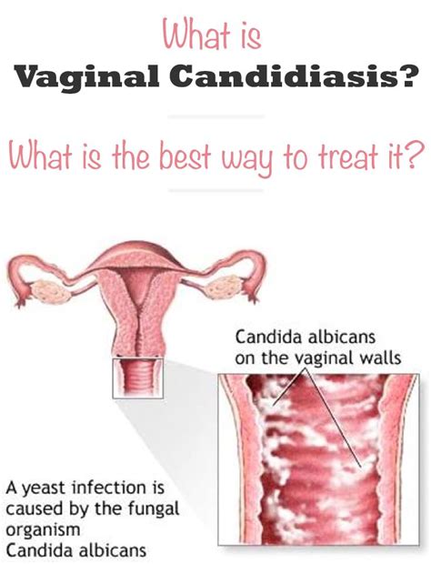What Is Vaginal Candidiasis What Is The Best Way To Treat It By Magazinez Net Natural