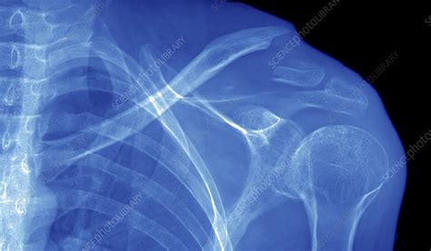 Collar Bone Fracture X Ray Stock Image C0482969 Science Photo