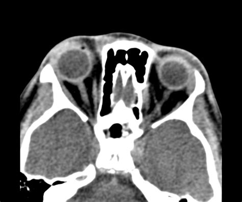 Internal Angular Orbital Dermoid Cyst Image
