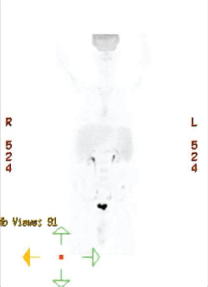 Pet Ct Scan Initial Pet Ct A Shows The Hypermetabolic Lesions