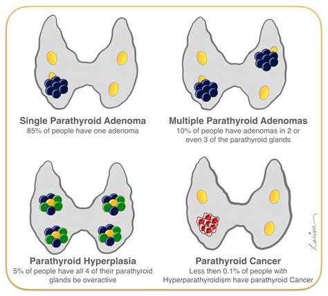 Parathyroid Adenoma Hyperplasia And Cancer Hyperparathyroidism