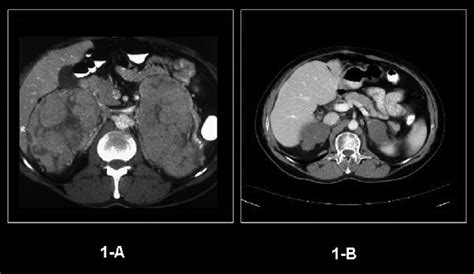 A Ct Scan Abdomen Axial View Following Iv Contrast Administration