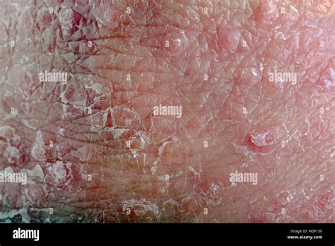 Macro Psoriasis Hi Res Stock Photography And Images Alamy