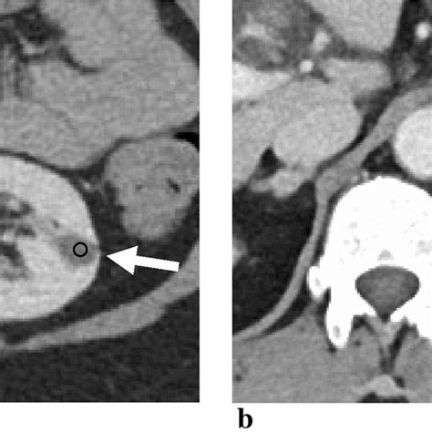 A Axial Contrast Enhanced Ct Image Obtained At Portal Venous Phase In A