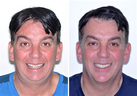 Case 11 Lower Jaw Surgery And Genioplasty Sydney Oral And Facial Surgery