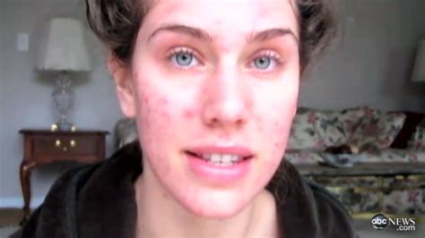 Watch This Acne Scarred Teen Transform Into A Flawless Model Business