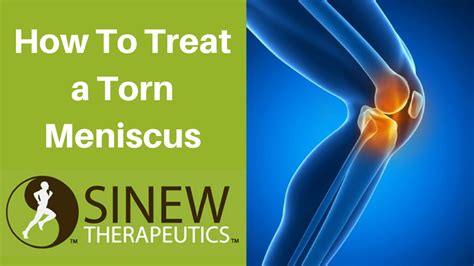 How To Treat A Torn Meniscus And Speed Recovery Youtube