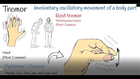 Tremor Shaking Hands Hand Tremors Causes And Treatment Parkinson