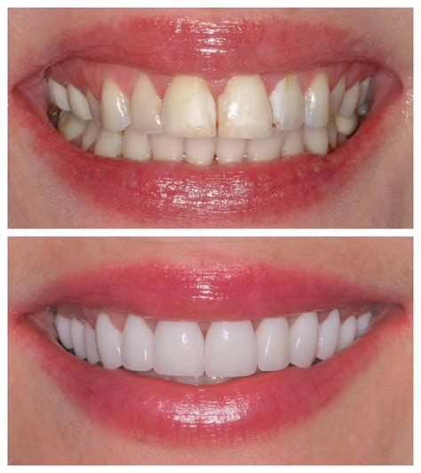 Feasible Threats Of Restoring Your Smile With Dental Veneers Lexcliq