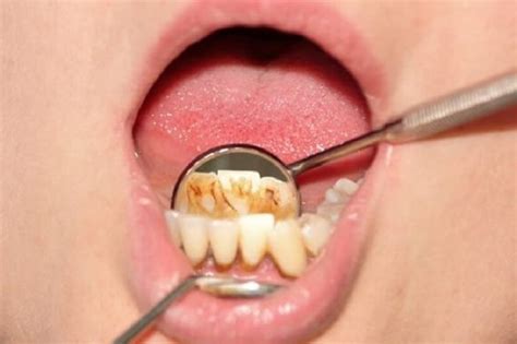 Que Es Curetaje Dental Y Cuando Hay Que Hacer El Tratamiento