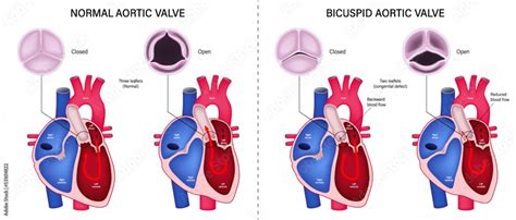 The Difference Of Normal Aortic Valve And Bicuspid Aortic Valve