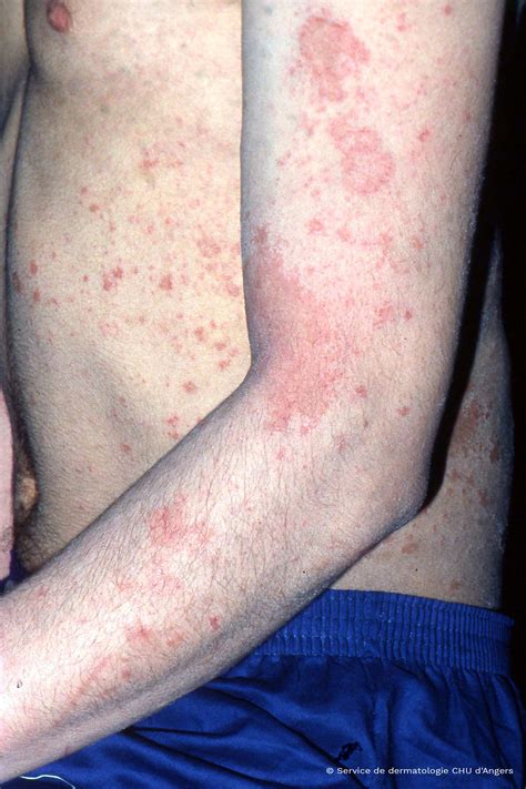 Eczema Bumps On Arms
