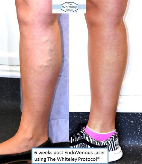 Varicose Vein Surgery Drbeckmann